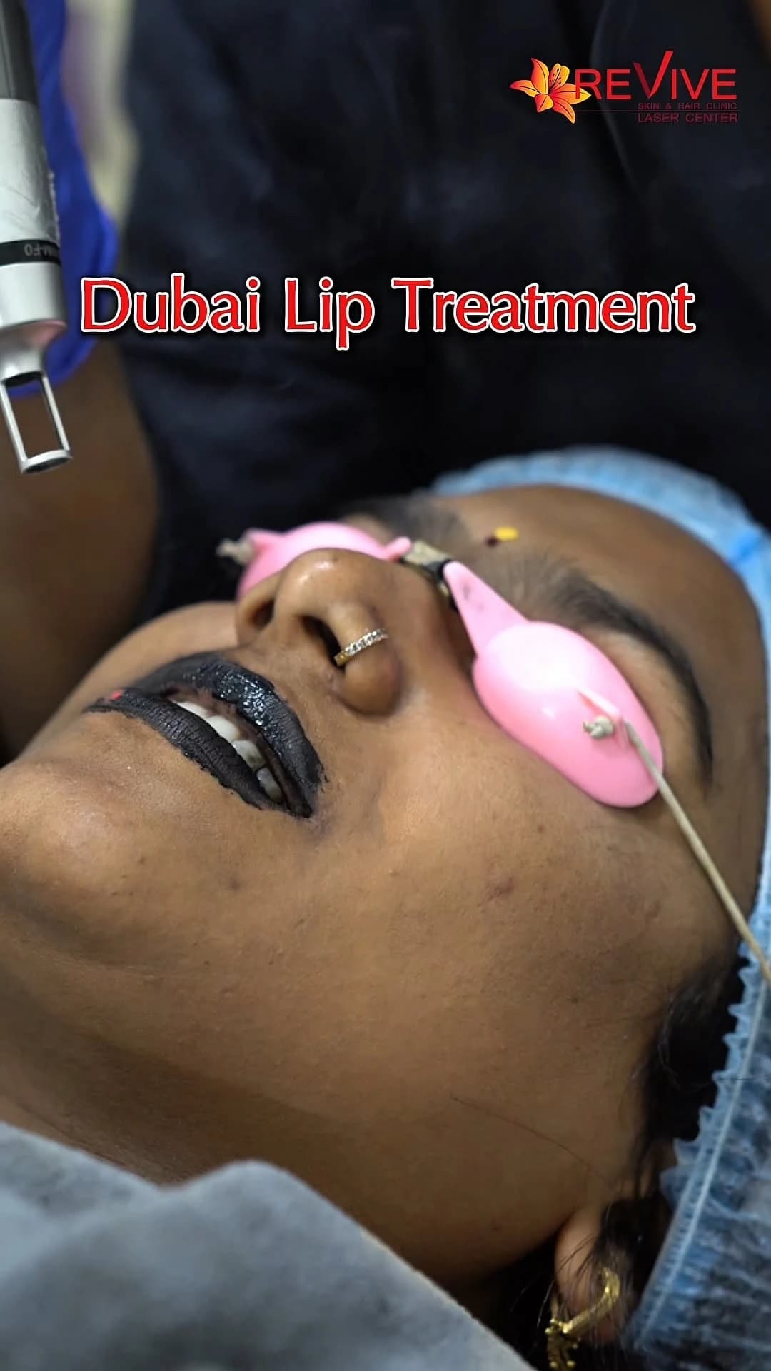 Dubai Lip Carbon Laser Treatment