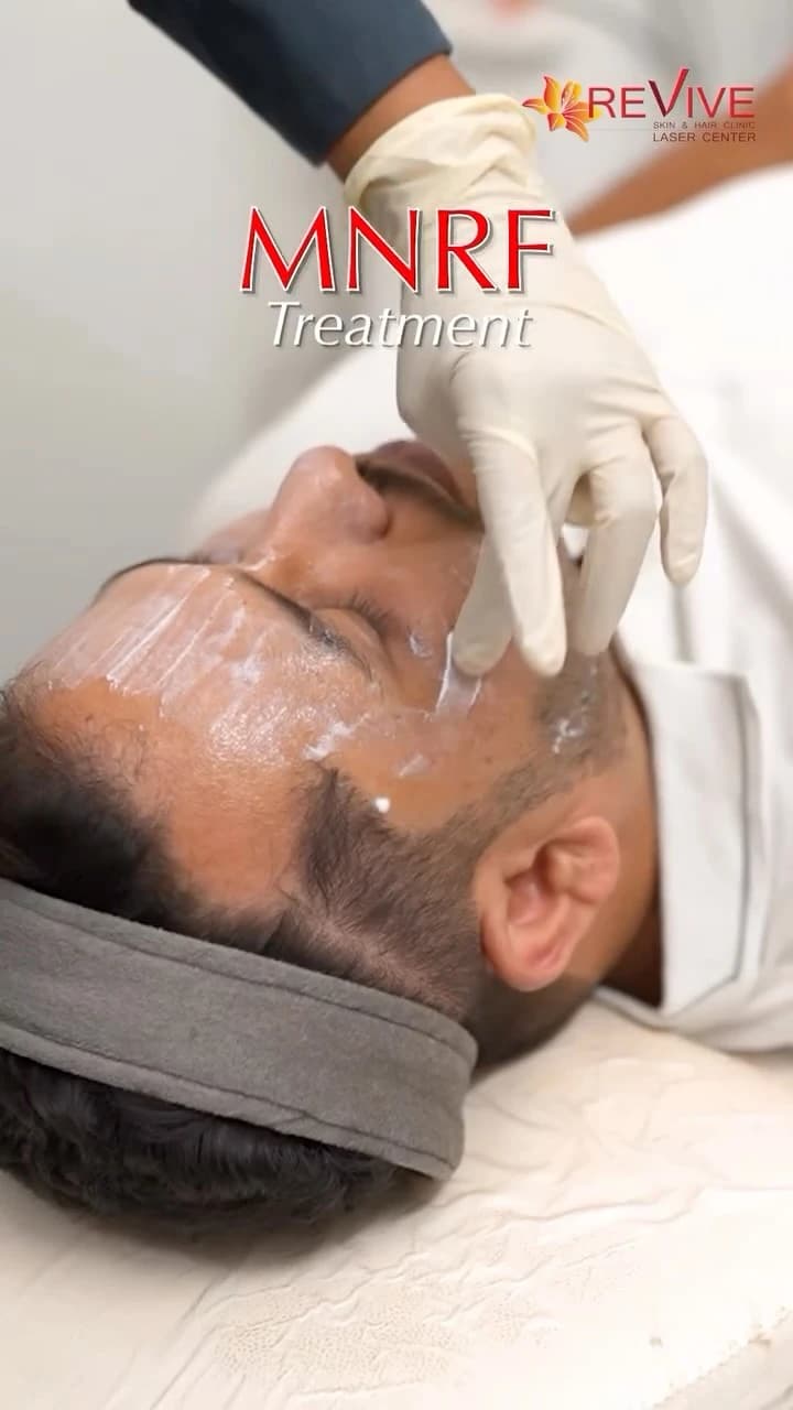 Advanced MNRF for Acne Scars