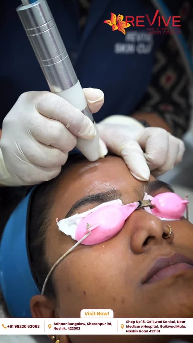 Laser Pigmentation Treatment