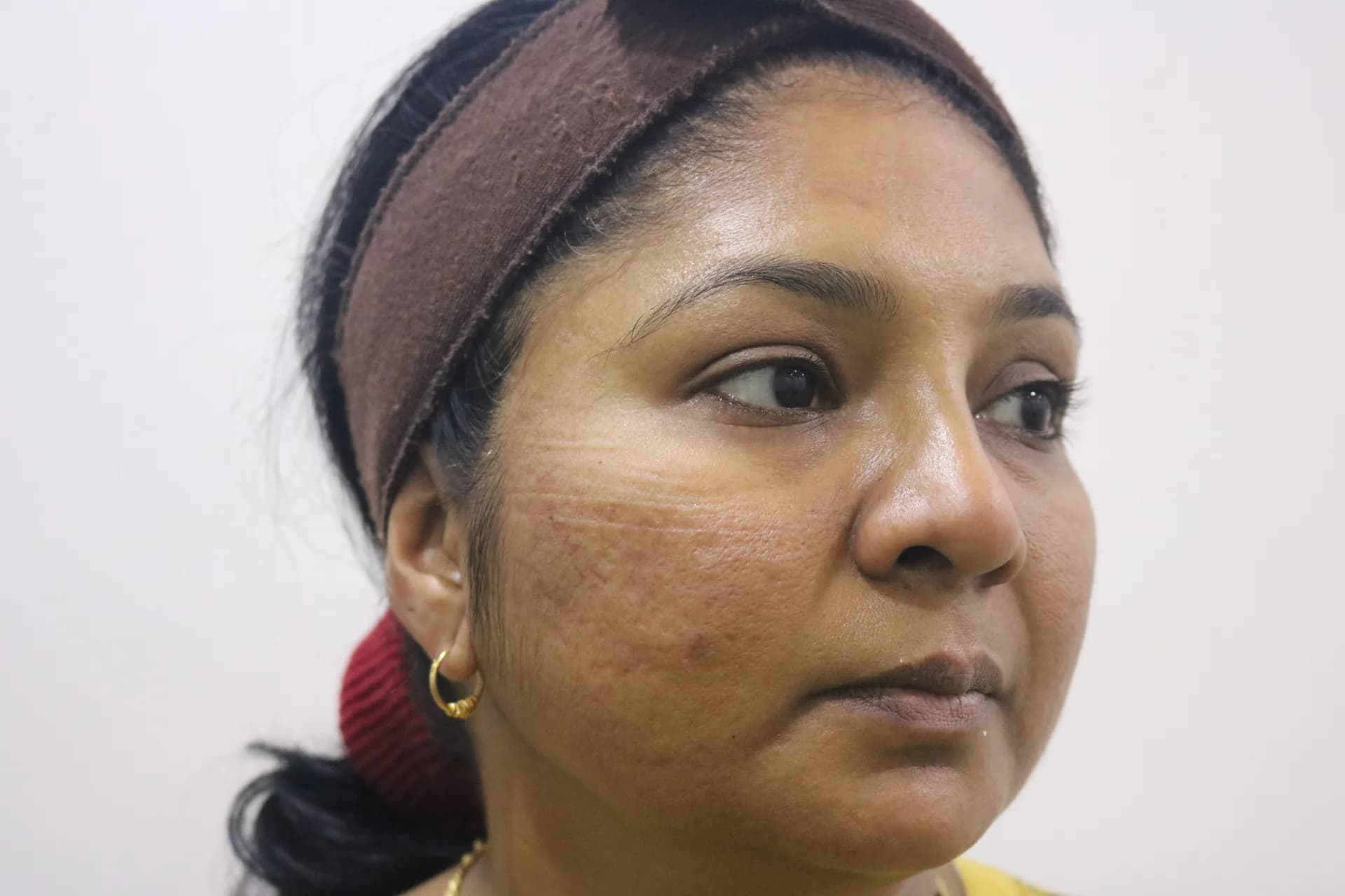 Before treatment