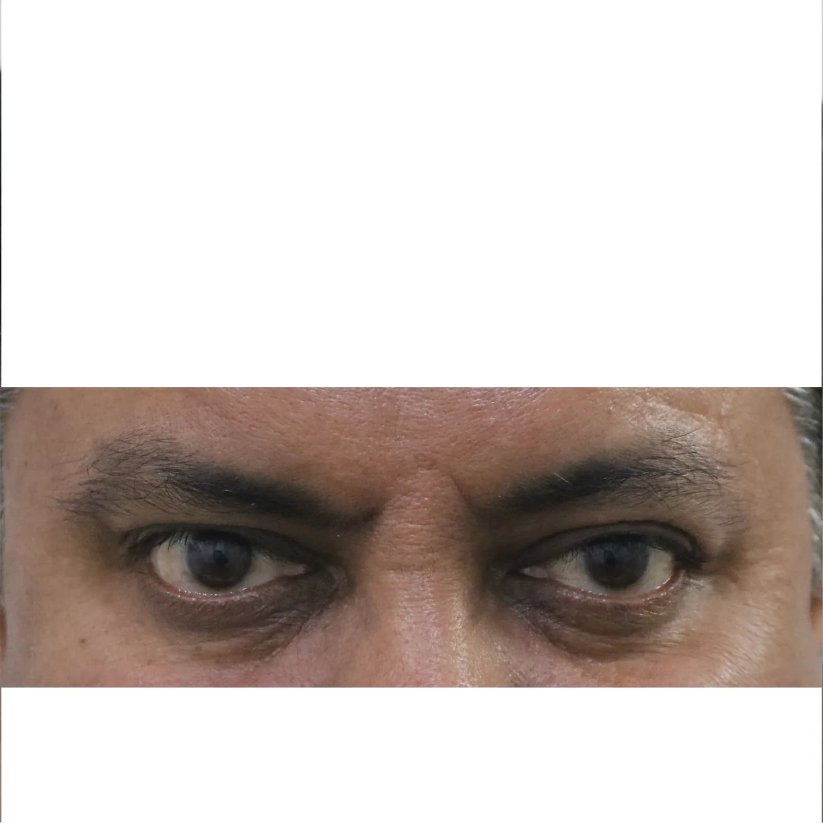 After Botox Treatment