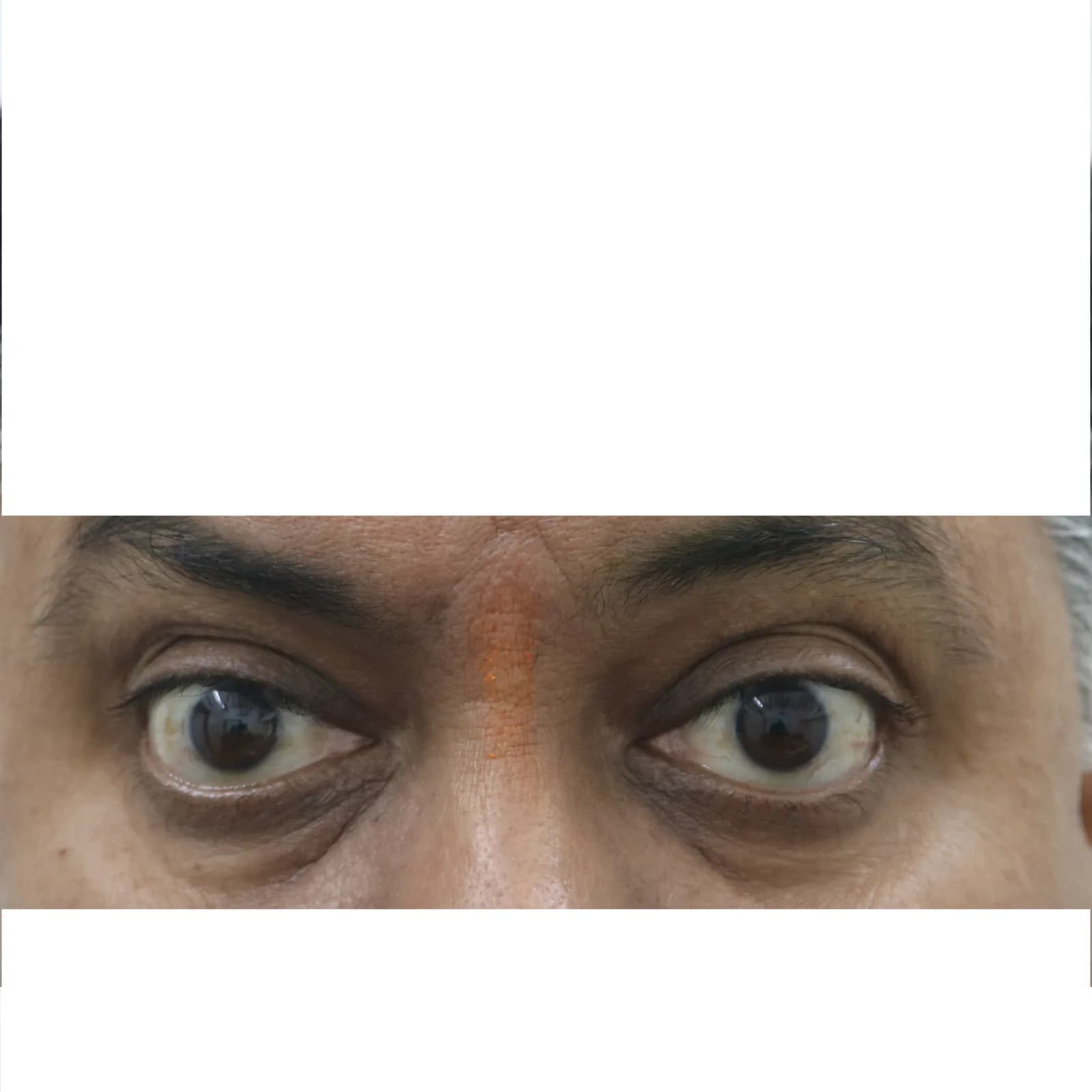Before Botox Treatment