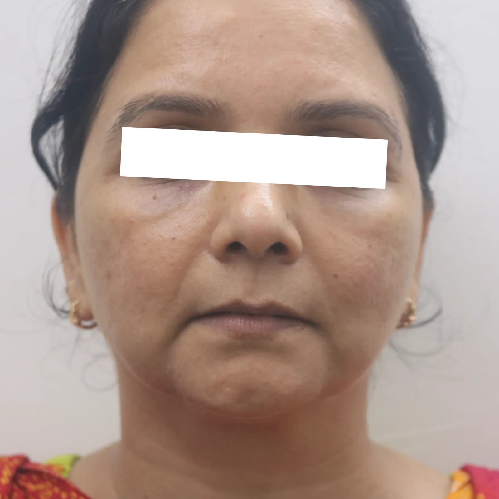 After Dermal Filler Treatment