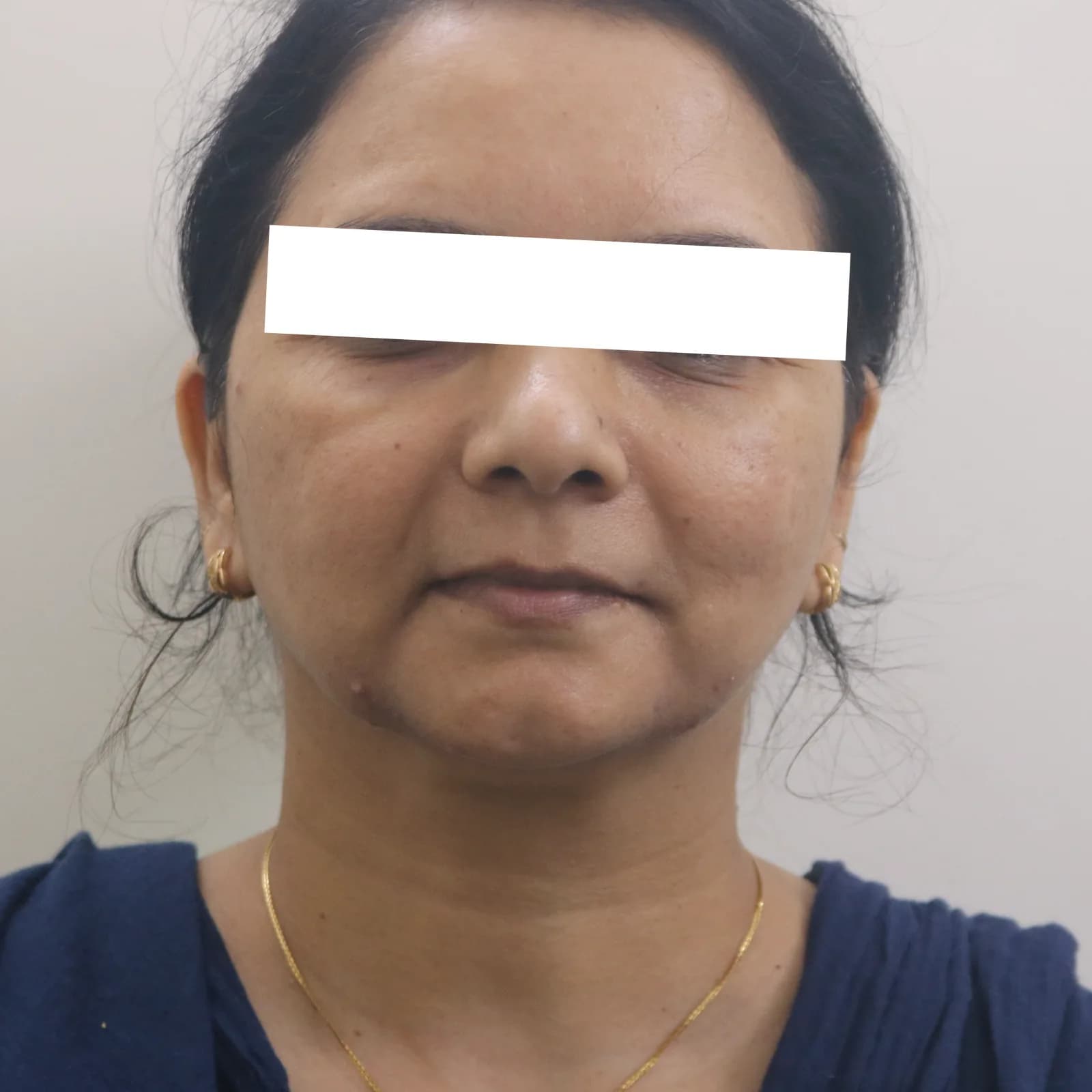 Before Dermal Filler Treatment