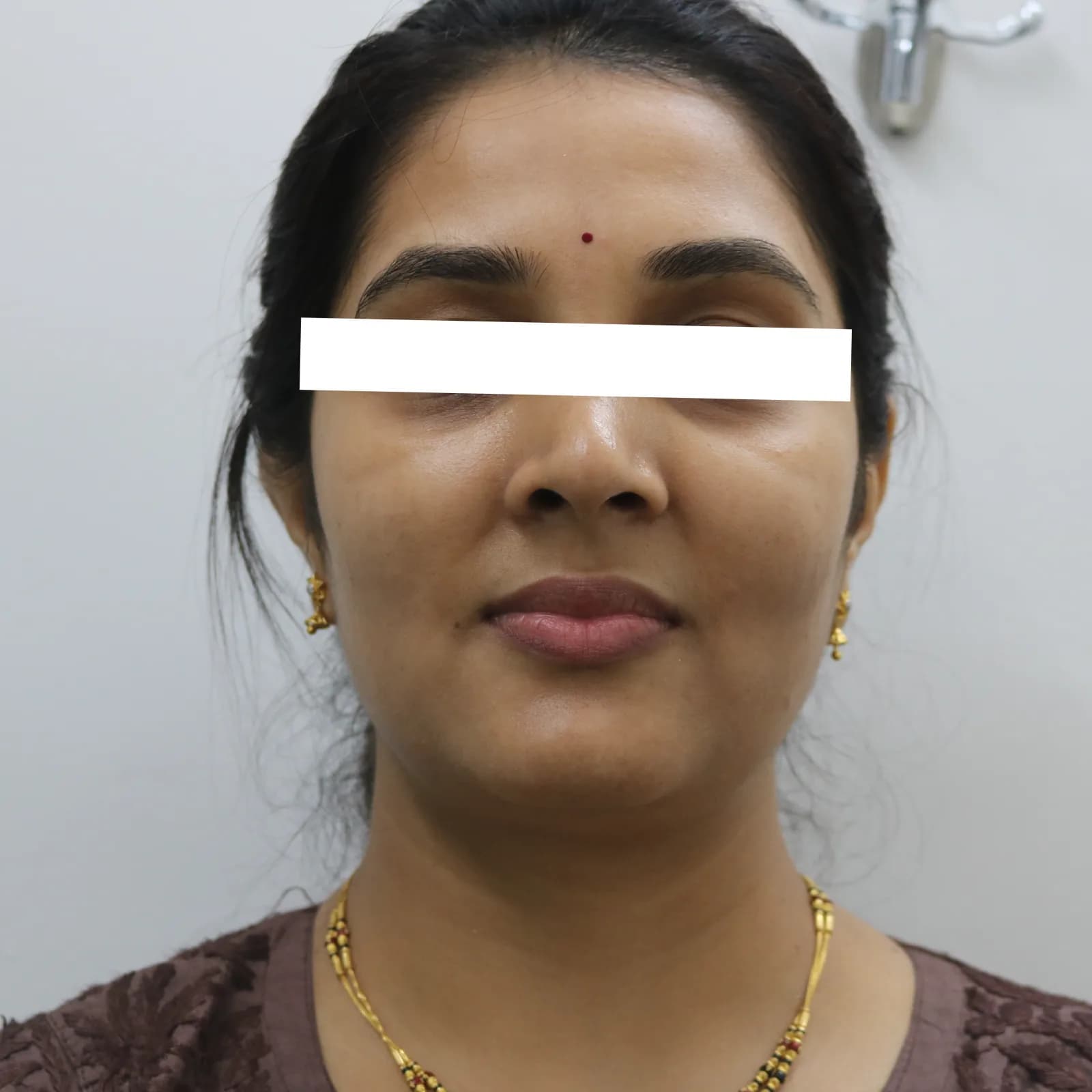 After HIFU Treatment