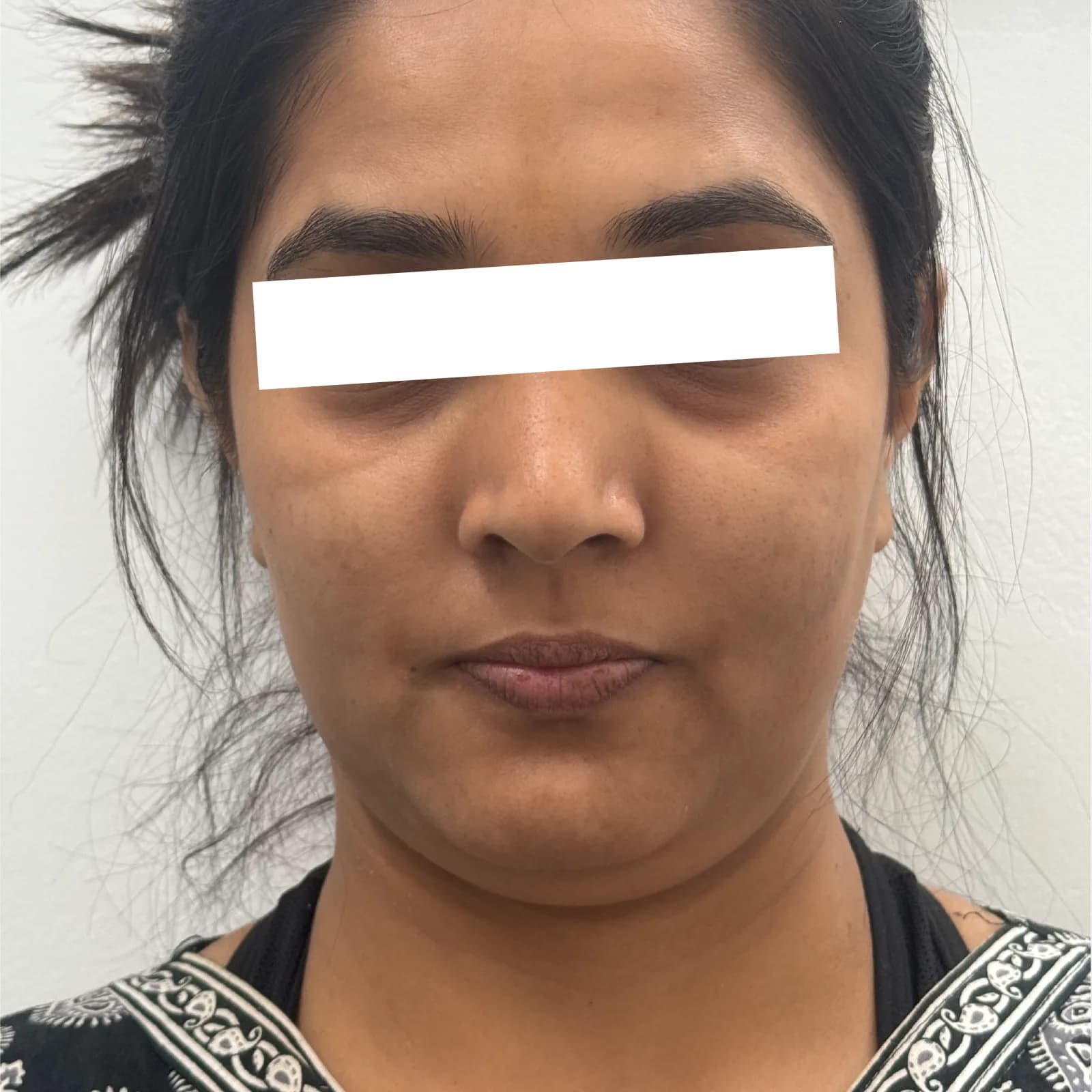 Before HIFU Treatment