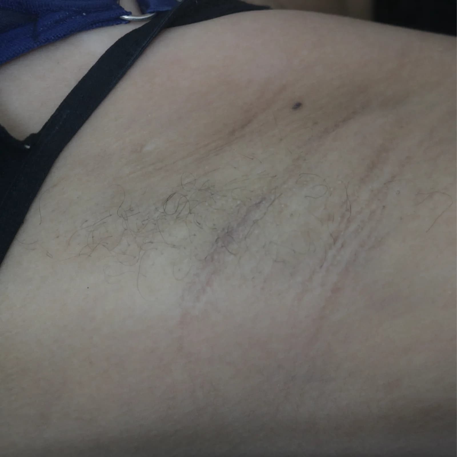 After Laser Hair Reduction