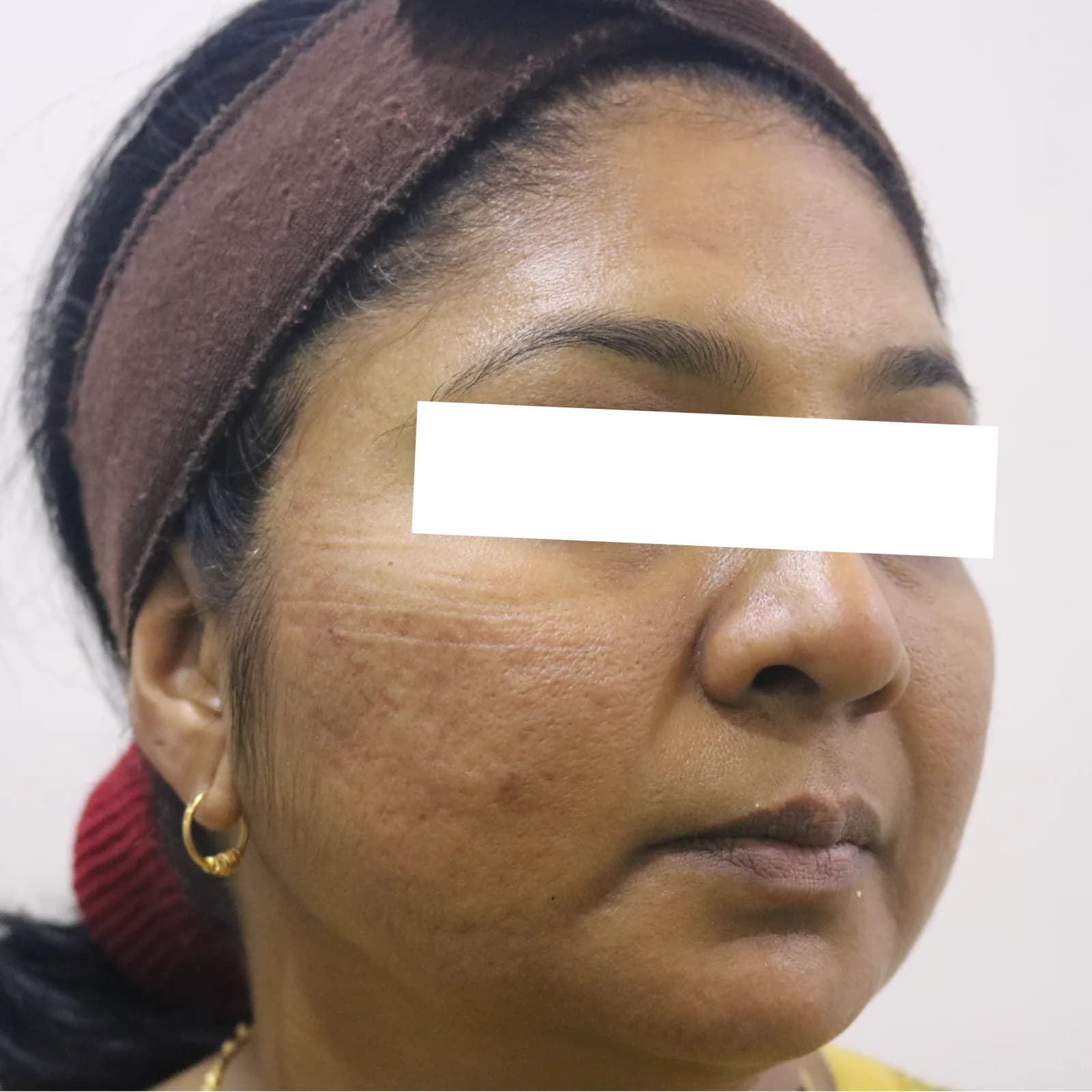 Before MNRF Treatment