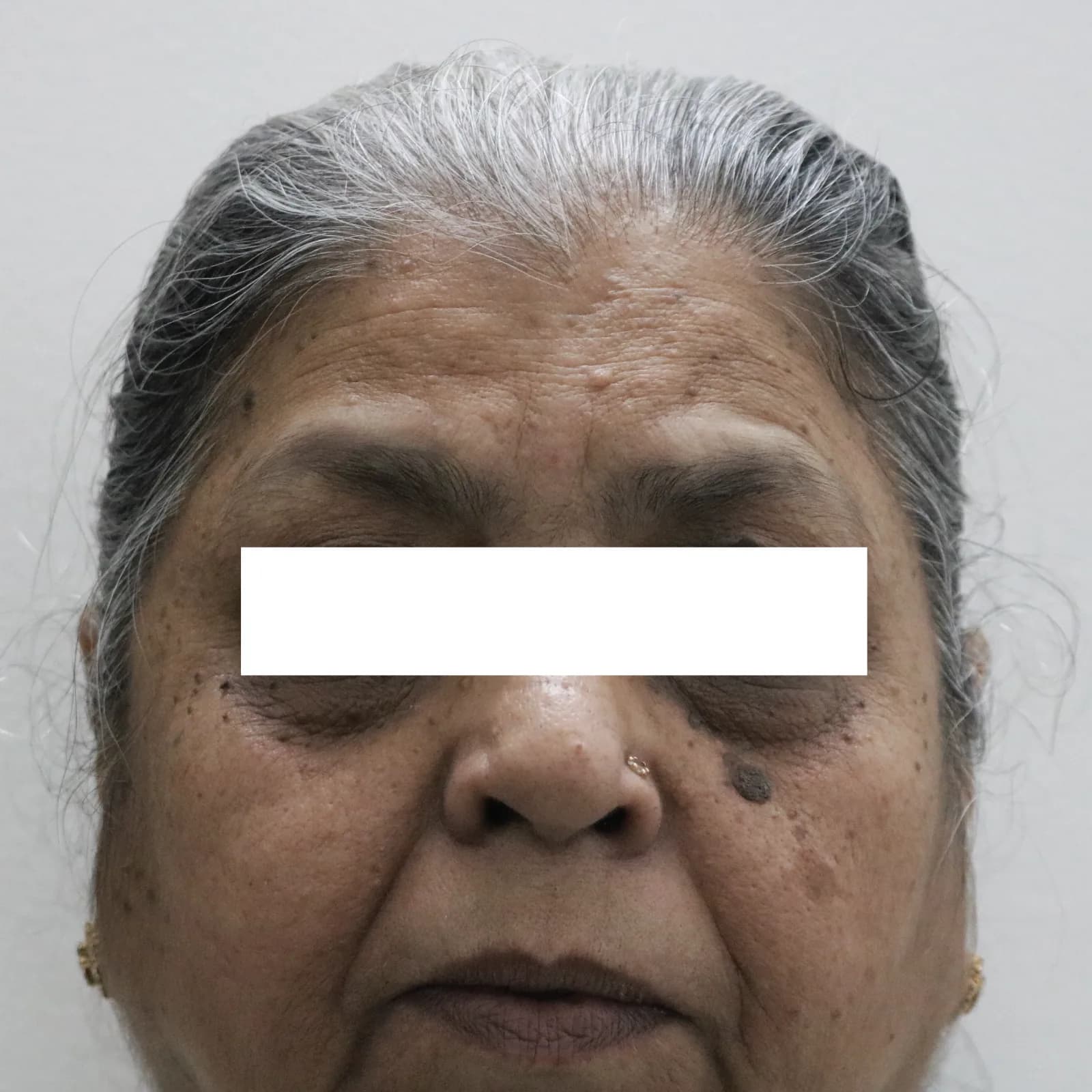 Before Radiofrequency Treatment