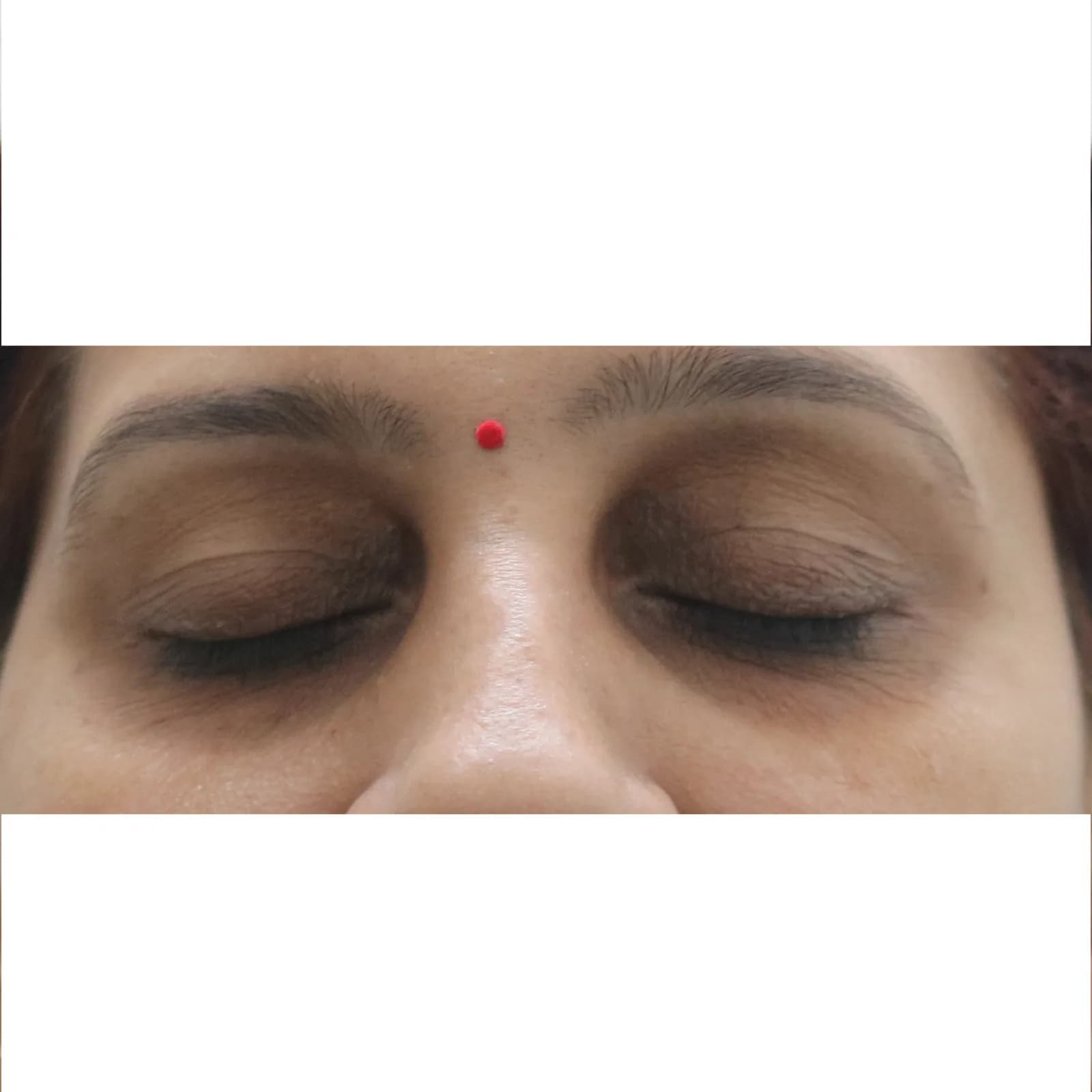 After Xanthelasma Treatment