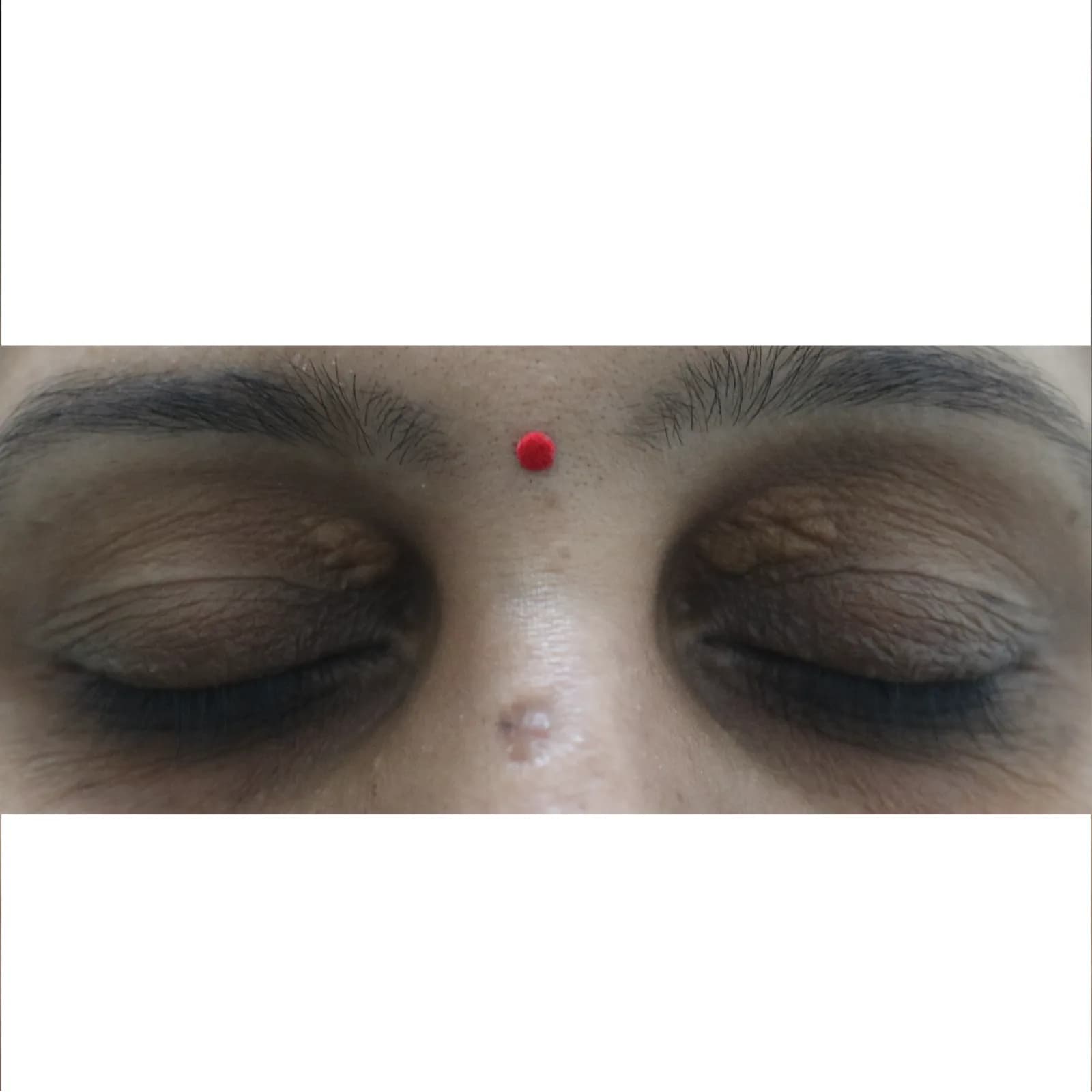 Before Xanthelasma Treatment