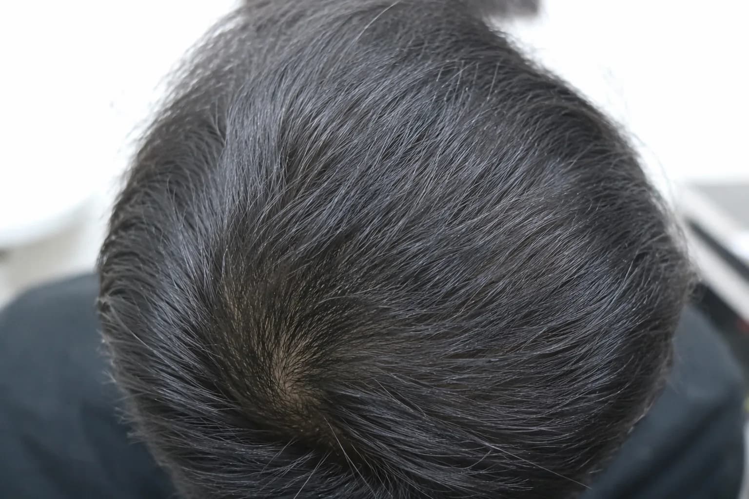 After PRP Hair Restoration (Scalp)