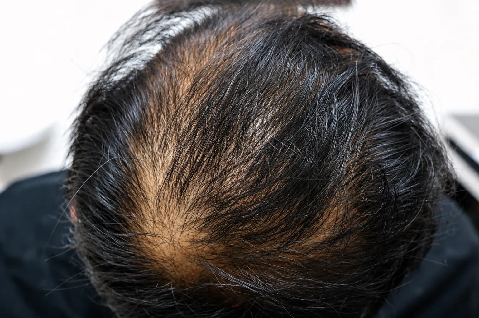 Before PRP Hair Restoration (Scalp)